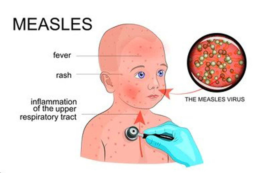 Measles breaks out in Valley’s Aarubari