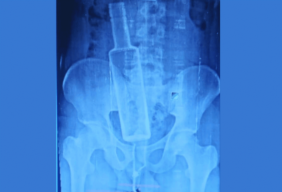 Bottle removed from man’s body after surgery