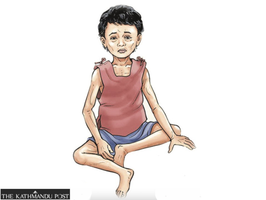 Budget cut hampers treatment of moderately acute malnourished children