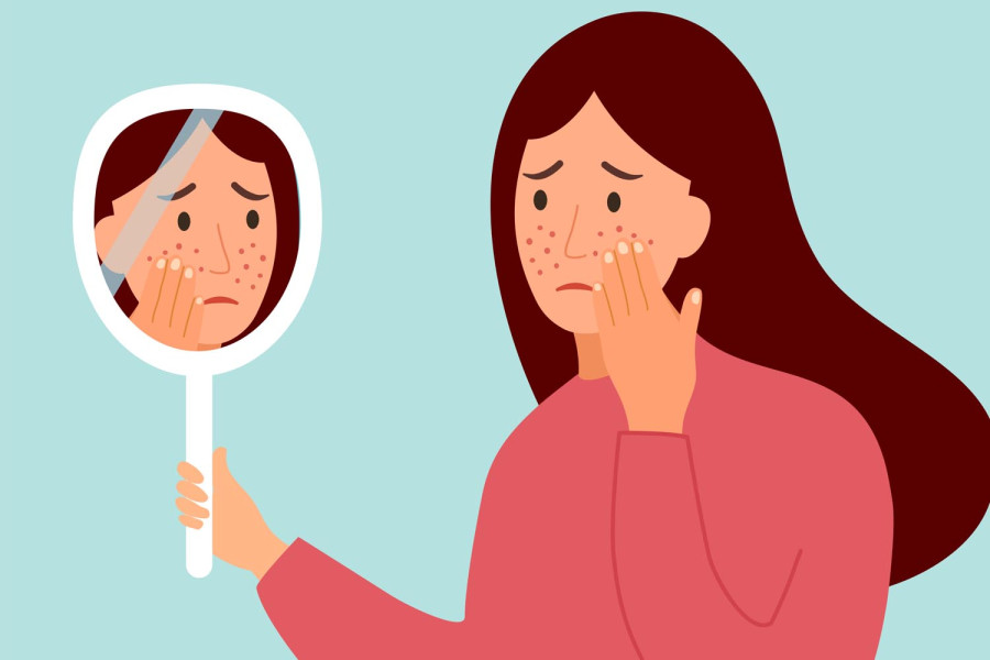 Healing post-inflammatory erythema