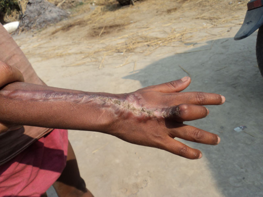 As snakes thrive in upper climes, more people dying from venomous bites