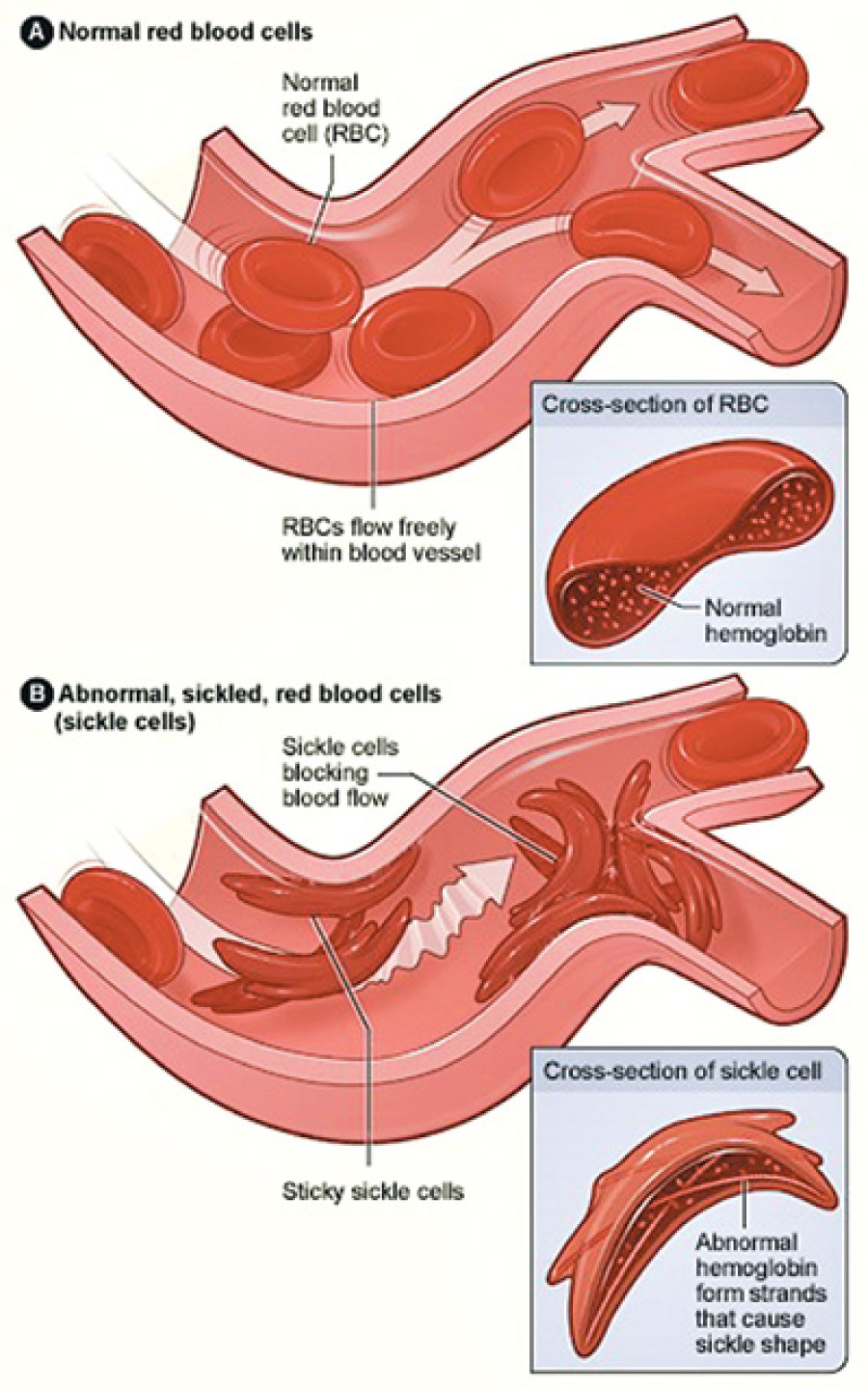 Sickle cell anaemia a major threat in Tharu community