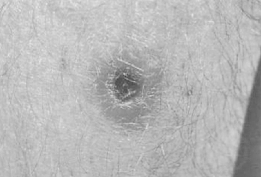 11 cases of scrub typhus reported in East, two dead