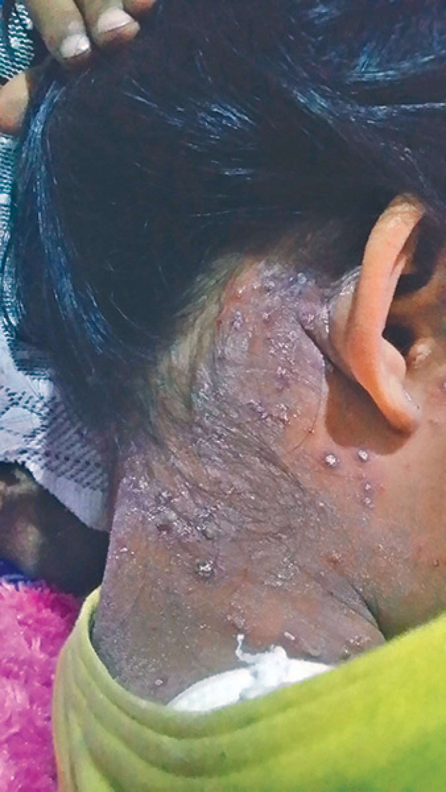 Chickenpox stalks children in Palpa