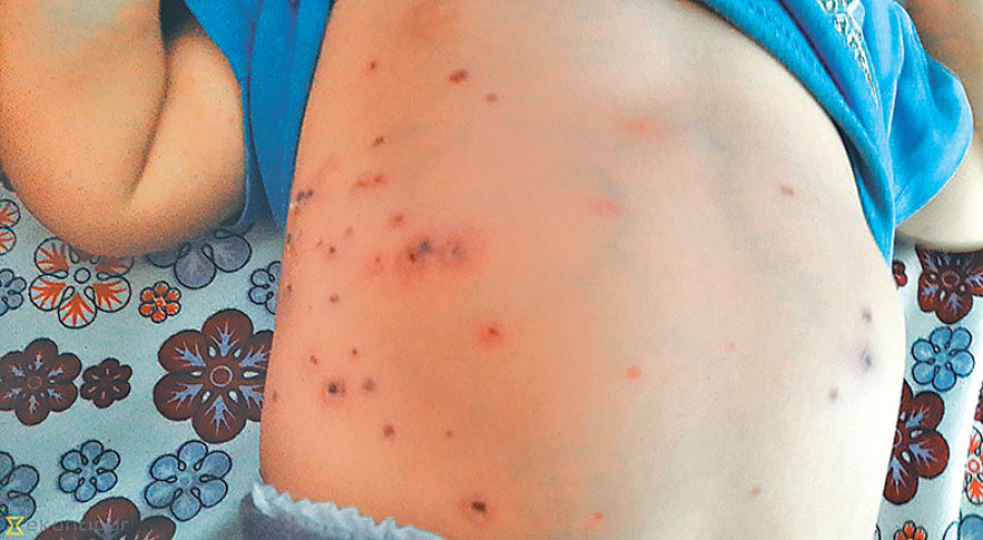Scrub typhus kills 4 people, infects 504 in one year