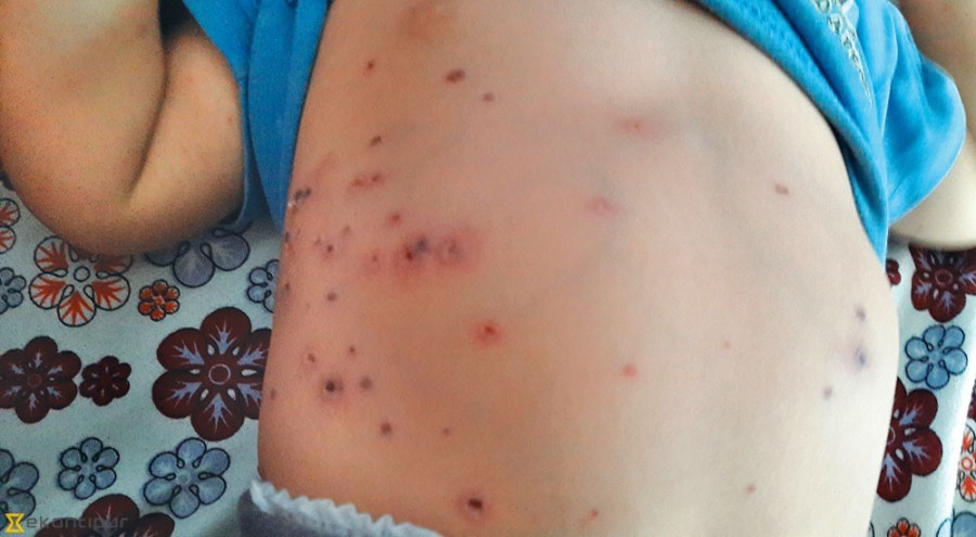 Patients deprived of free test for lack of diagnostic kits