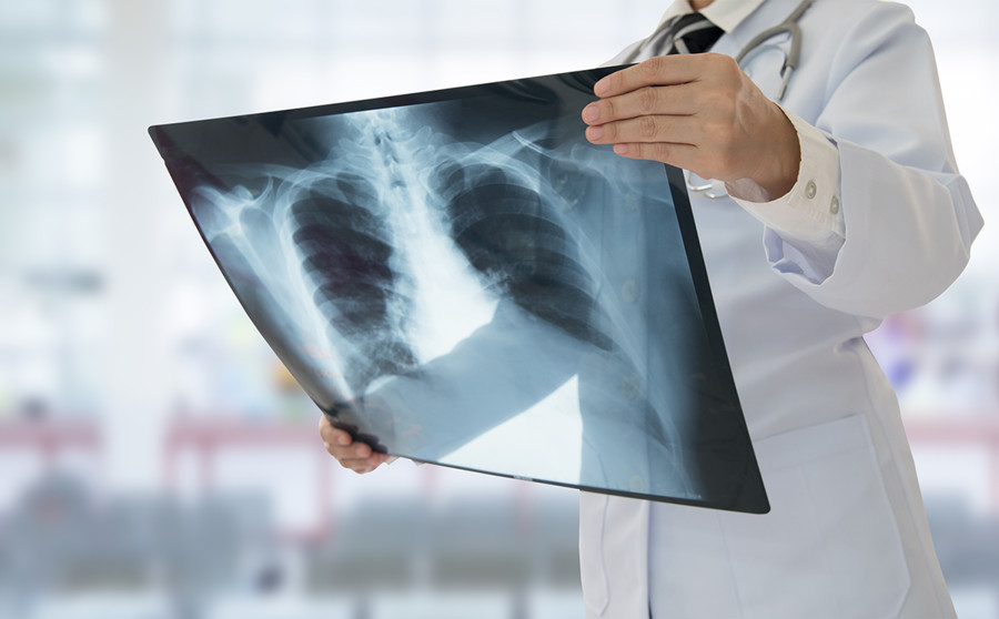 Makwanpur sees rise in the number of tuberculosis patients
