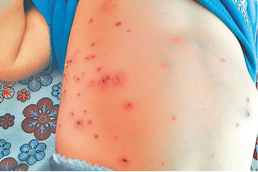 Scrub typhus mounts public health challenge in Chitwan district