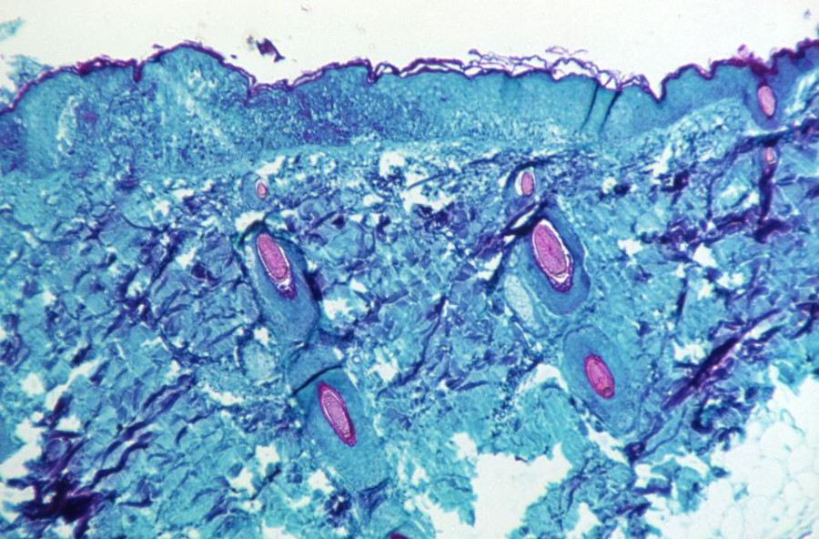 What vaccines, treatments do we have to combat monkeypox?