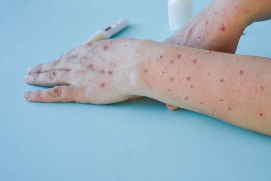 Worried about mpox? No need to