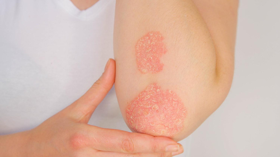 Managing psoriasis