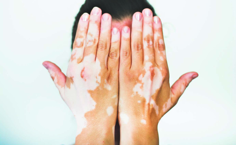 All about vitiligo