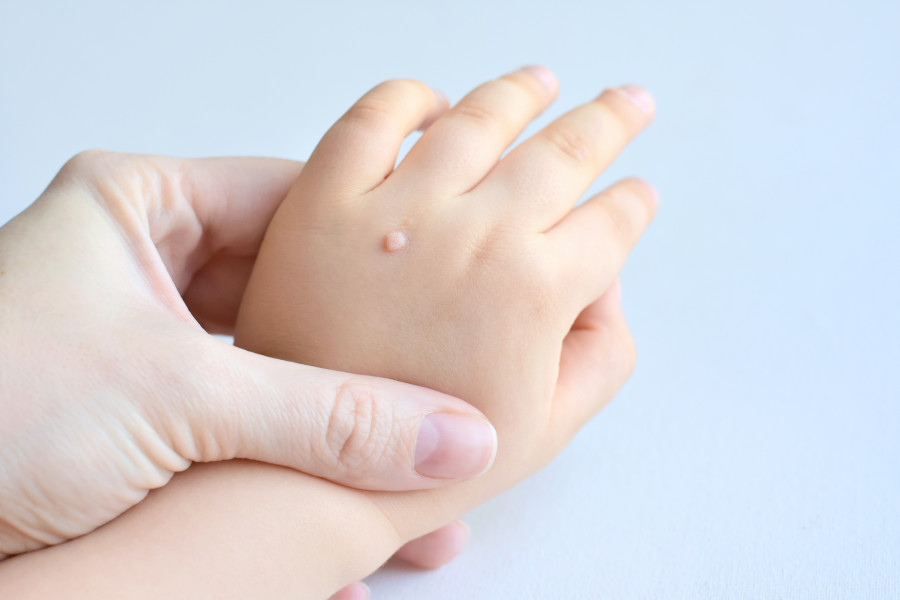 Understanding warts