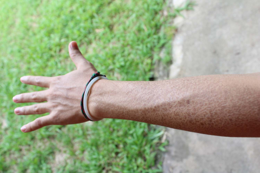 Insights into ichthyosis