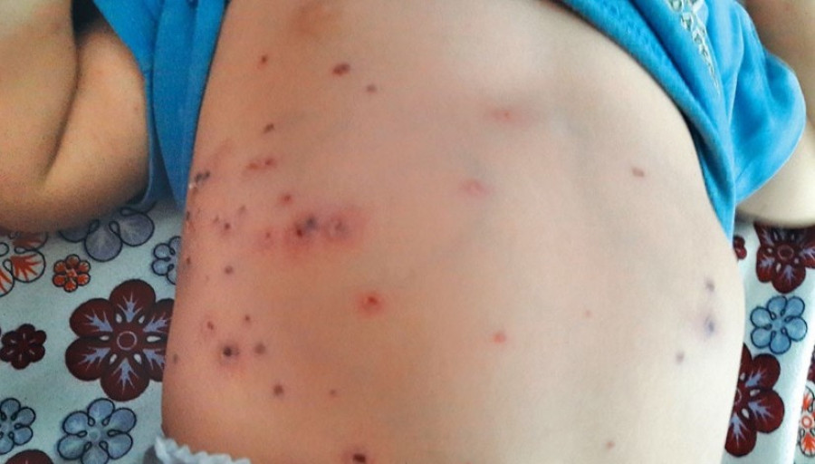 Over 2,200 people infected with scrub typhus this year