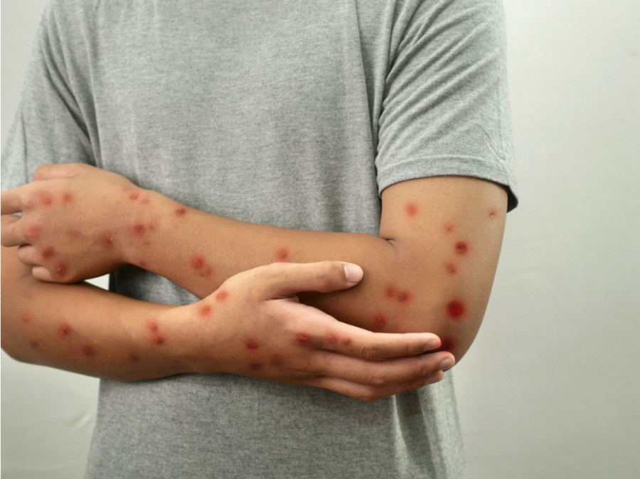 Mpox and its threats