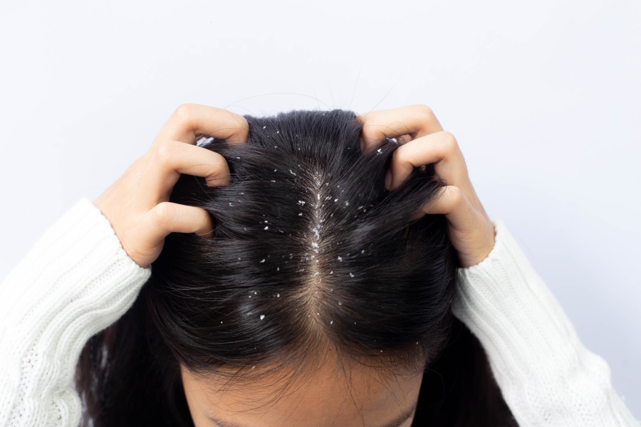 Combating winter dandruff