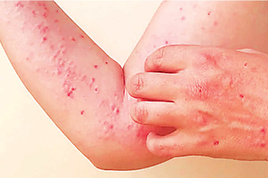 Nepal confirms third mpox case. Experts warn of possible spread