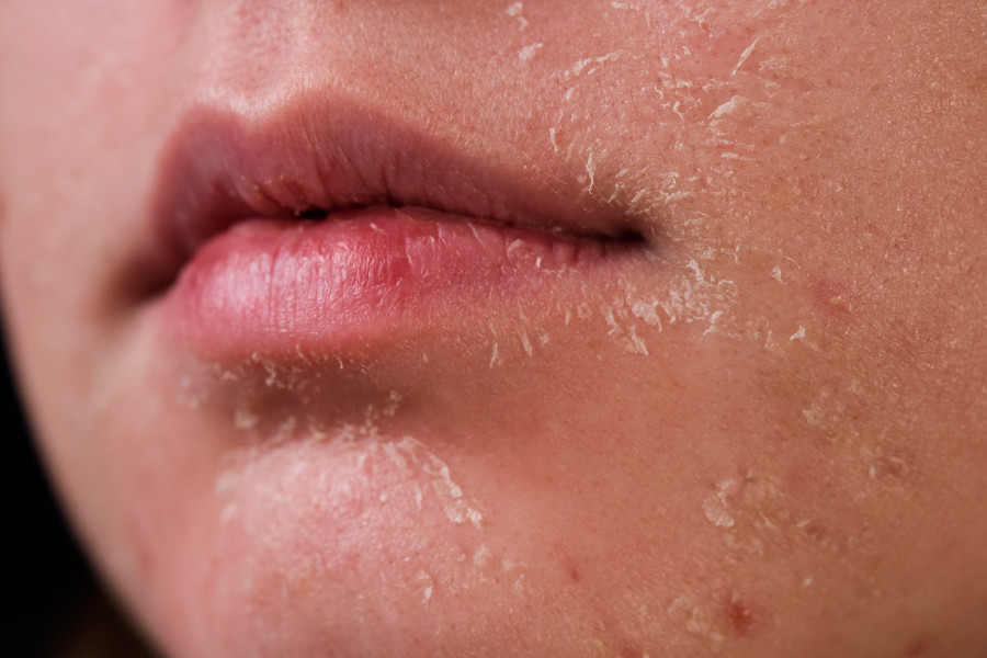 Keeping skin healthy in dry seasons