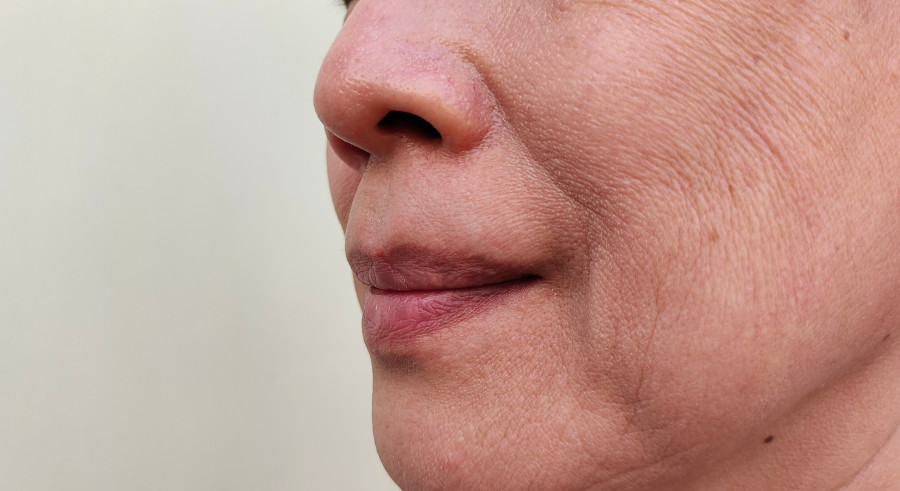 Dealing with wrinkles