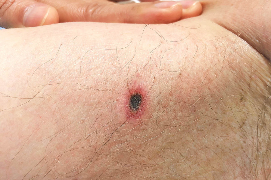 Over 3,500 infected with scrub typhus since mid-July