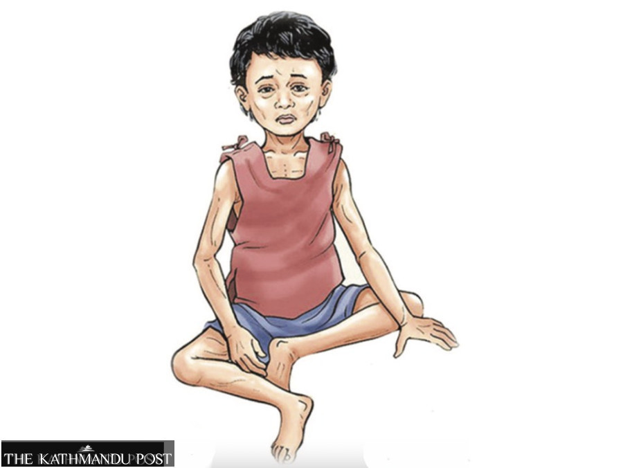 Malnutrition continues to afflict children in Nepal’s food basket