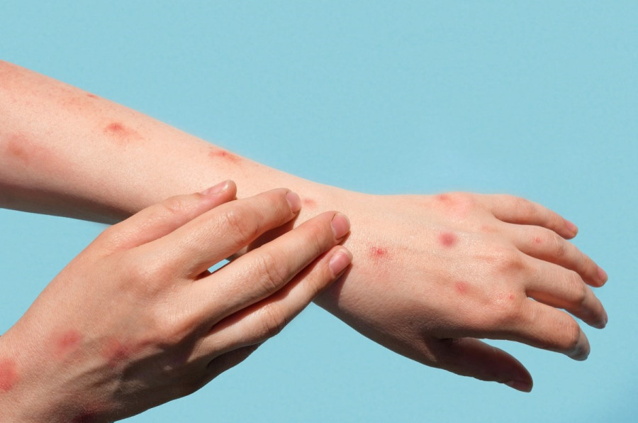 Imported mpox in Nepal