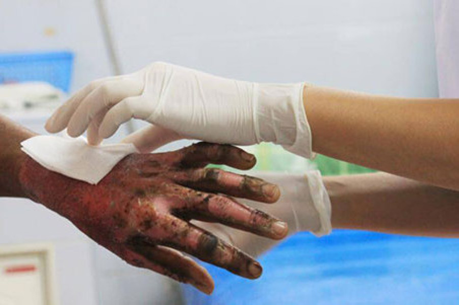 After the burn