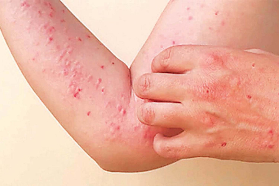 WHO lab confirms clade IIb mpox in two Saudi Arabia returnee Nepalis