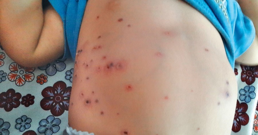 12-year-old girl dies of scrub typhus in Palpa