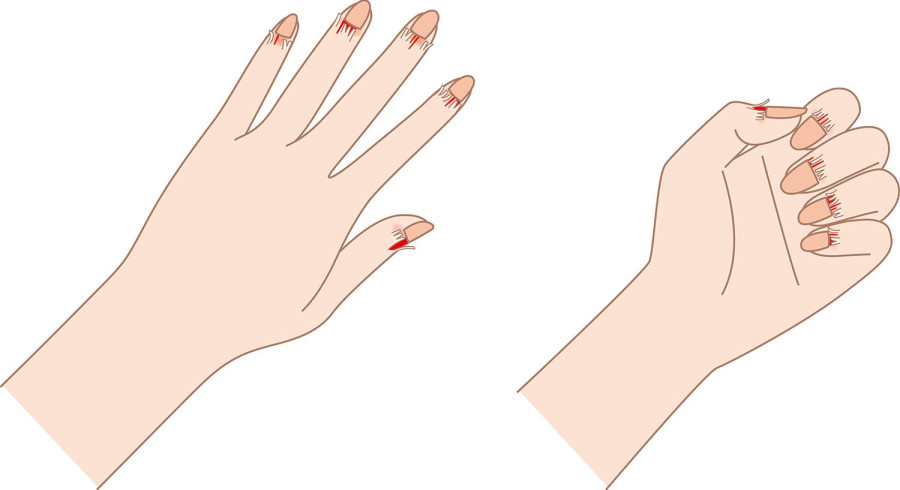 What causes skin peeling around fingernails